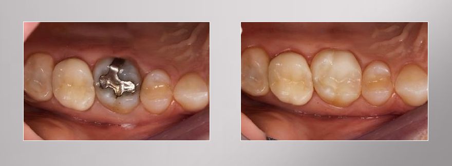 CEREC avant et après réparation